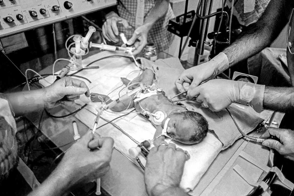 Preemie Baby unit at St Joseph's Hospital. Preemie baby within minutes of birth in the I.C.U. Shown are an Endo-tracheal tube, an umbilical catheter, a chest tube being inserted and an electrode.